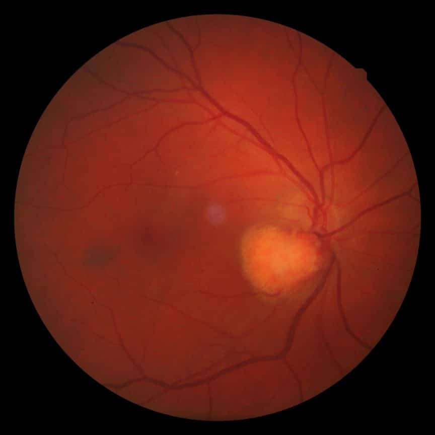 Clinical Photography Astrocytoma Spectrum