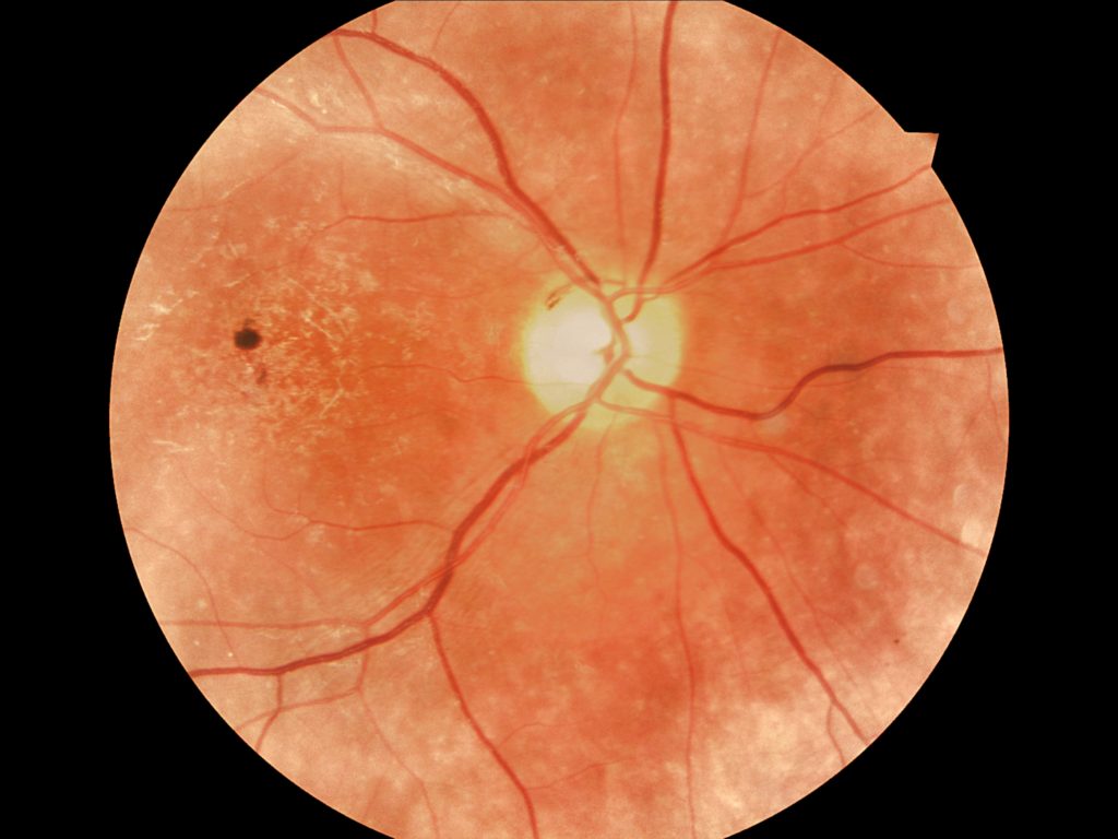 IP CMG Article – Part 6 Managing medical retinal conditions