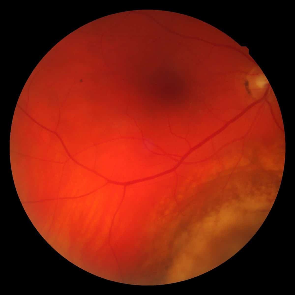 grandmother-s-photopsia-diagnosed-as-choroidal-melanoma-spectrum