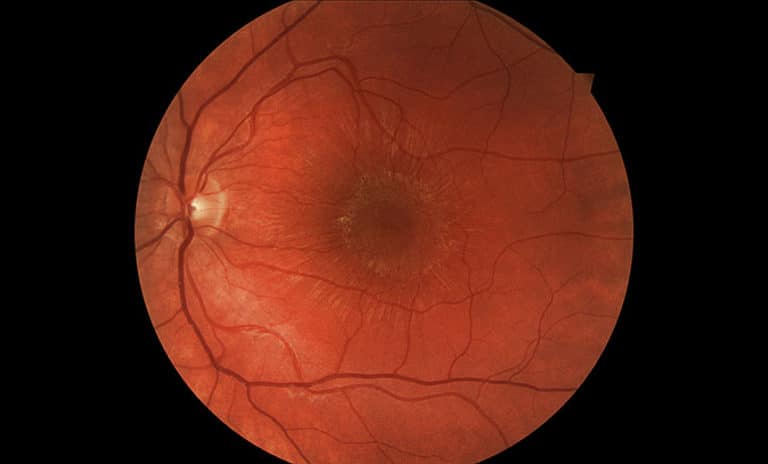 Clinical photography - Stellate maculopathy | Spectrum