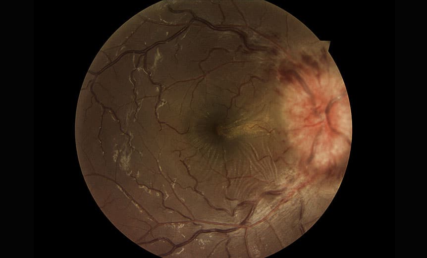 Clinical photography – Papilloedema | Spectrum