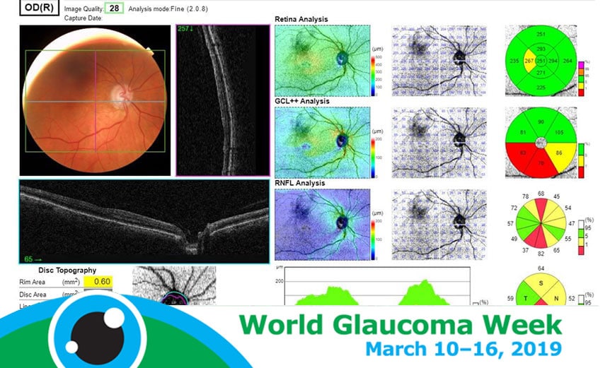 case study for glaucoma