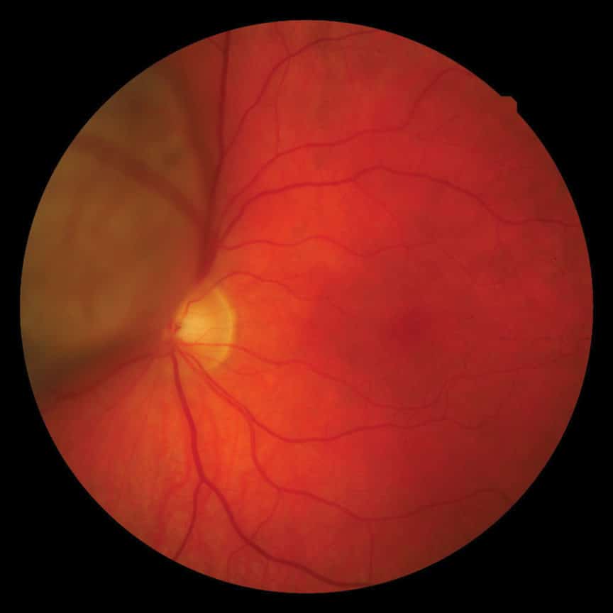 Clinical photography Choroidal melanoma Spectrum